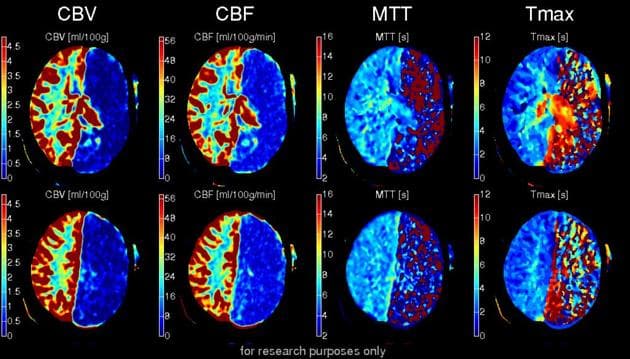 AI-Powered CT Perfusion Analysis for Acute Stroke Assessment