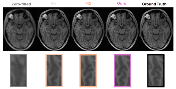 Deep Learning MRI Image Restoration: Swin Transformer Architecture