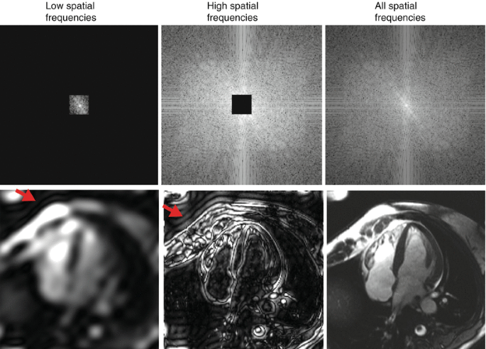 Frequency Domain Filtering in MRI